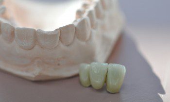 At shepherds hill dental centre we offer a variety of treatment options to help repair a cracked tooth